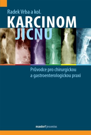 Karcinóm pažeráka - Sprievodca pre chirurgickú a gastroenterologickú prax - VÝPREDAJ